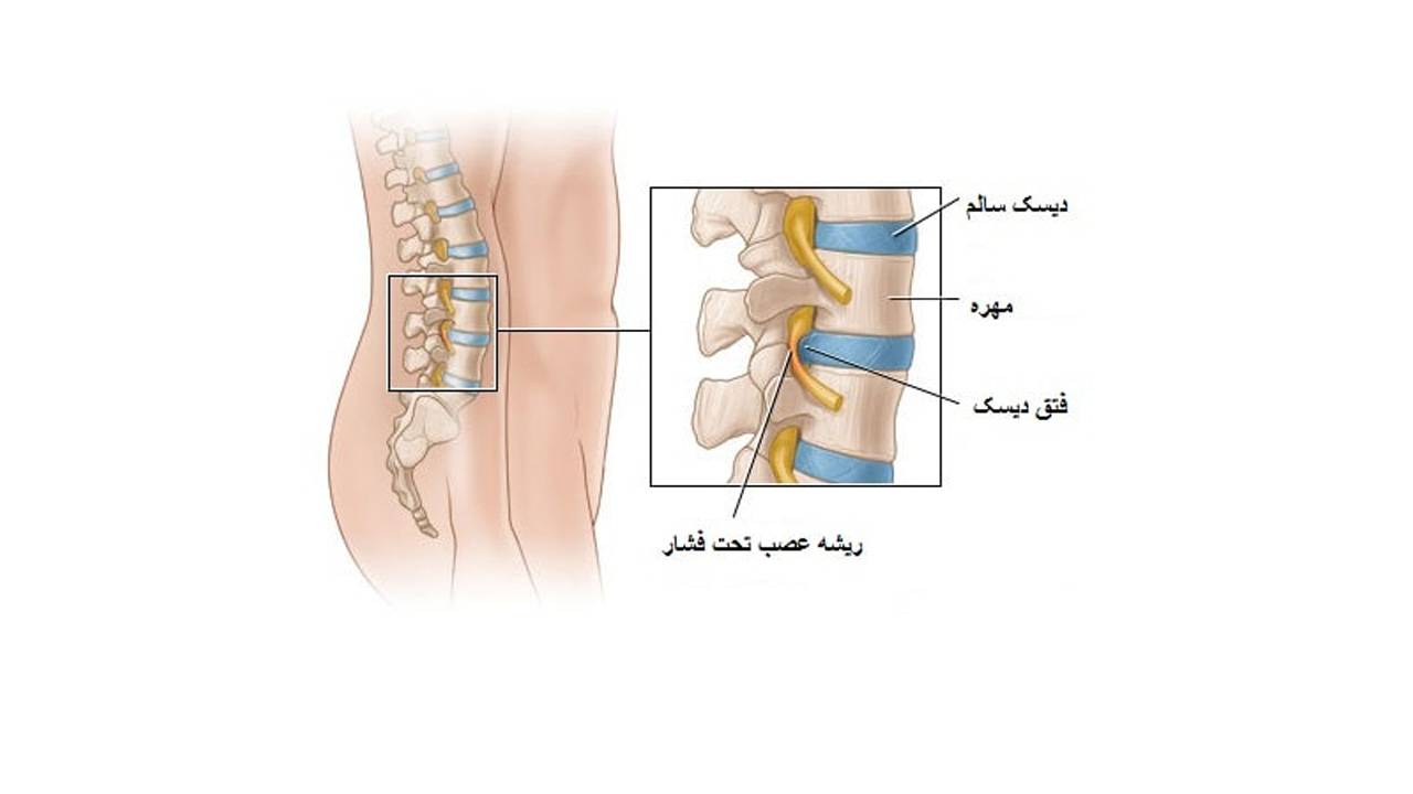 درمان سریع درد دیسک کمر با 5 روش خانگی در منزل